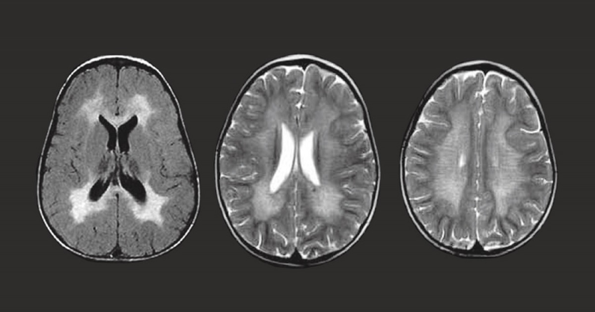 leucodistrofia-metacrom-tica-s-ntomas-causas-y-tratamiento