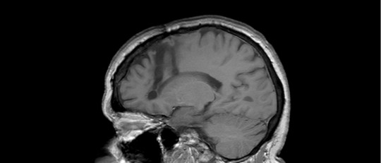 Los efectos de la lobotomía cerebral