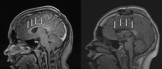 Síndrome de desconexión del cuerpo calloso