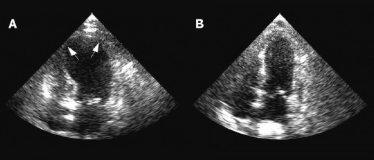 Miocardiopatía de tako-tsubo