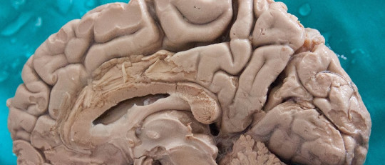 Hemisferio cerebral derecho