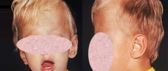 Macrocefalia: causas, síntomas y tratamiento