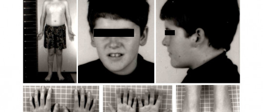 Síndrome de Prader-Willi: causas, síntomas y tratamiento