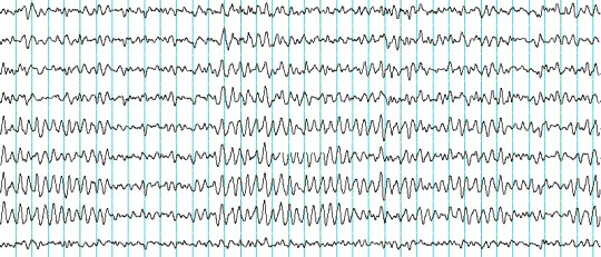 Electroencefalograma (EEG): ¿qué es y cómo se usa?