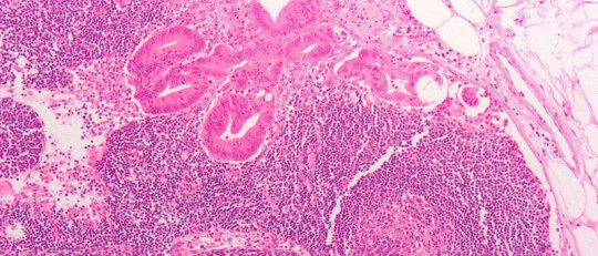 Cáncer de colon: 8 síntomas de alerta