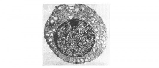 Síndrome de Pearson