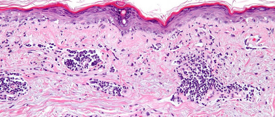 Lupus eritematoso sistémico