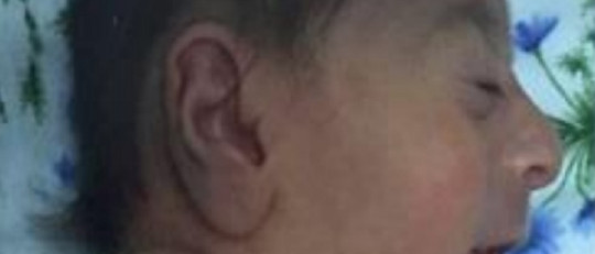 Síndrome de Stromme