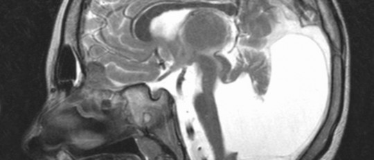 Malformación de Dandy Walker: causas, síntomas y tratamiento