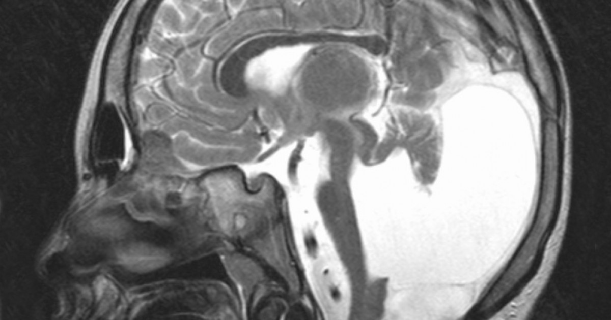 Malformación de Dandy Walker causas, síntomas y tratamiento