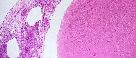 Meningitis: causas, síntomas, tratamiento y pronóstico