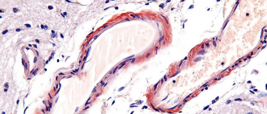 Microangiopatía cerebral: síntomas, causas y tratamiento