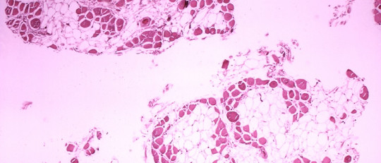 Distrofia muscular de Duchenne: qué es, causas y síntomas