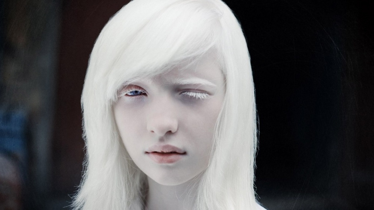 Personas albinas: genética y problemas que sufren