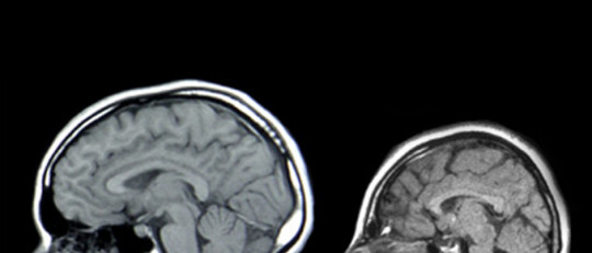 Síndrome de Edwards (trisomía 18): causas, síntomas y tipos