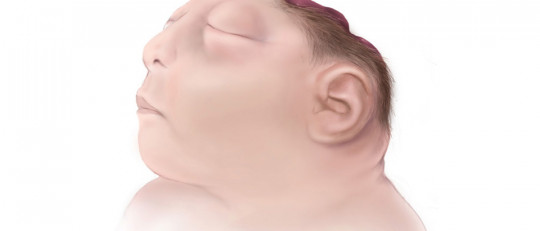 Anencefalia: causas, síntomas y prevención