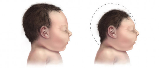 Microcefalia: síntomas, características y tratamiento