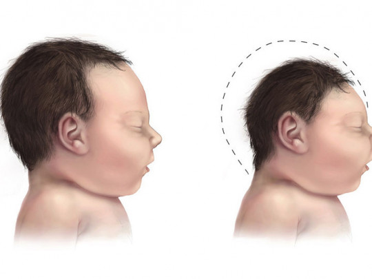 Síndrome de rubinstein taybi - canalSALUD