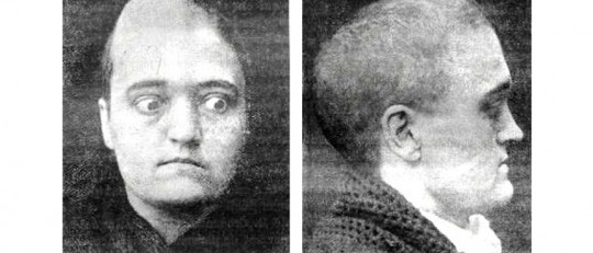 Síndrome de Crouzon: síntomas, causas e intervención