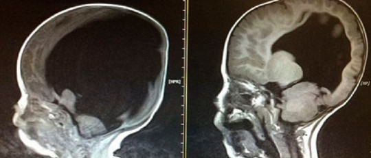 El extraño caso de Noah, el niño sin cerebro