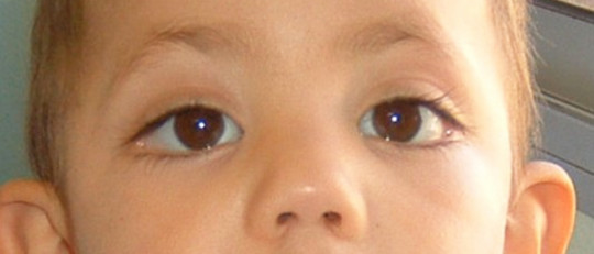 Síndrome de Kabuki: síntomas, causas y tratamiento