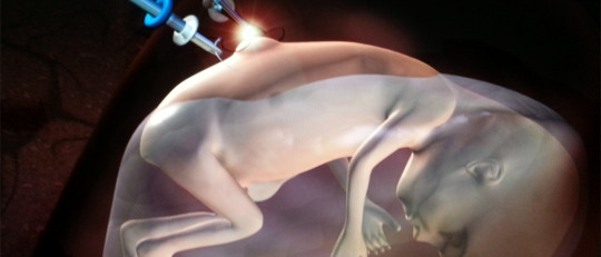 Espina bífida: tipos, causas y tratamiento