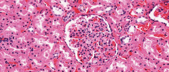 Enfermedad de Pick: causas, síntomas y tratamiento