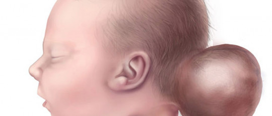 Encefalocele: tipos, causas, síntomas y tratamiento