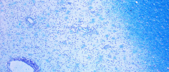 Las 15 enfermedades del sistema nervioso más comunes