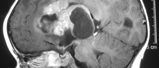 Tumor cerebral: tipos, clasificación y síntomas
