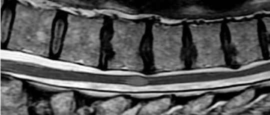 Mielitis transversa: qué es, síntomas, causas y tratamiento