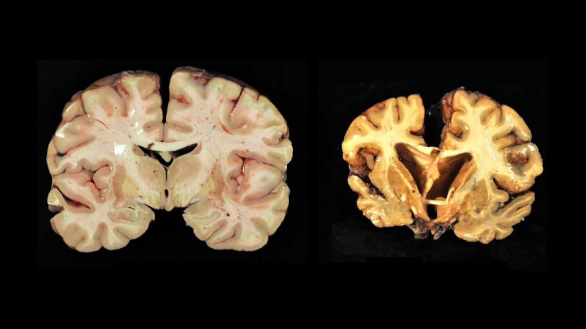 https://pymstatic.com/80201/conversions/encefalopatia-traumatica-cronica-wide.jpg