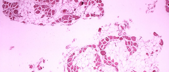 Enfermedad de Steinert: causas, síntomas y tratamiento