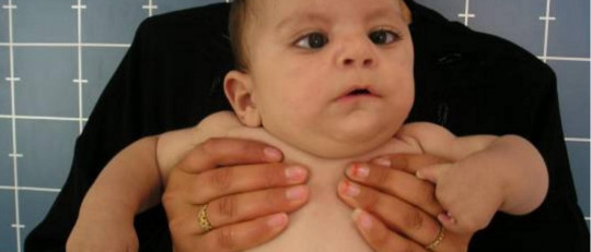 Síndrome de Moebius: causas, síntomas y tratamientos