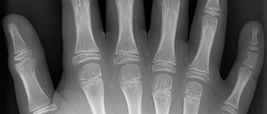 Síndrome de Bardet-Biedl: causas y síntomas principales