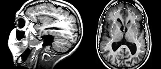 Polimicrogiria: causas, síntomas y efectos