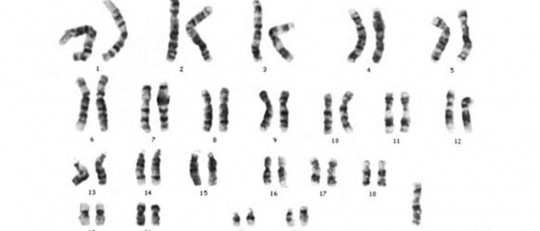 Síndrome de Turner: síntomas, tipos, causas y tratamiento