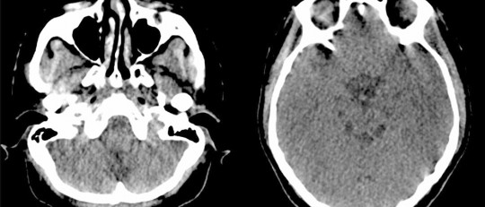 Síndrome de Pfeiffer: causas, síntomas y tratamientos