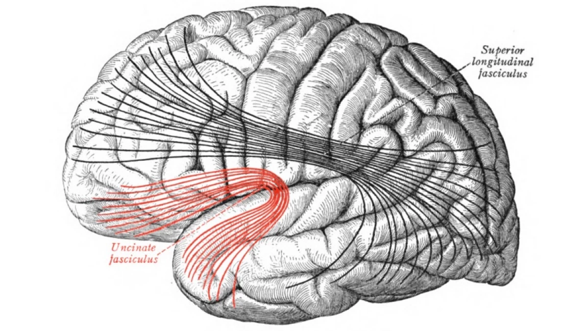 Fasciculo Arqueado Afasia= Alteración De Lenguaje A Consecuencia De