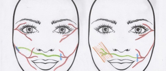 Síndrome de Ramsay Hunt: causas, síntomas y tratamiento