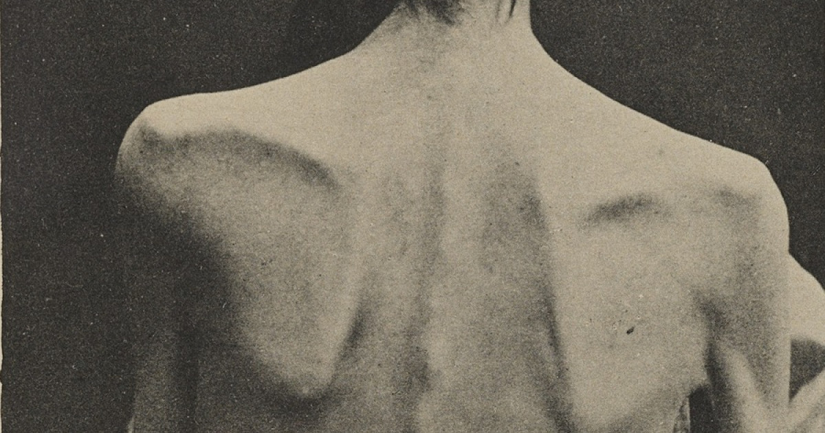 Caquexia: síntomas, causas y tratamiento