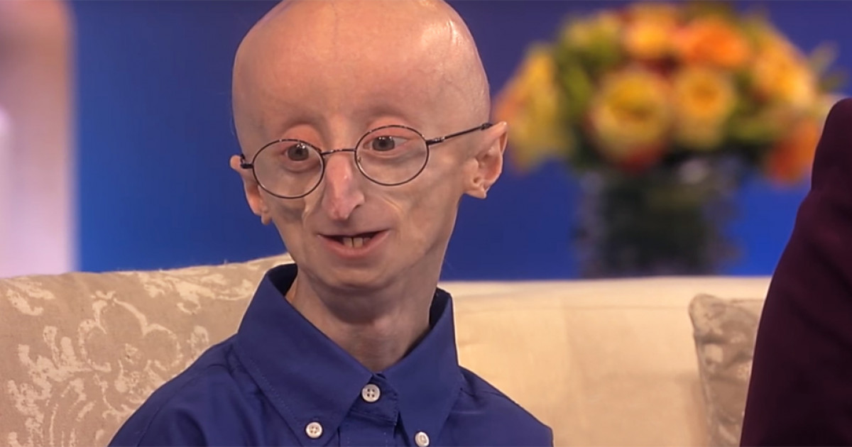 Progeria Causas Síntomas Y Tratamiento