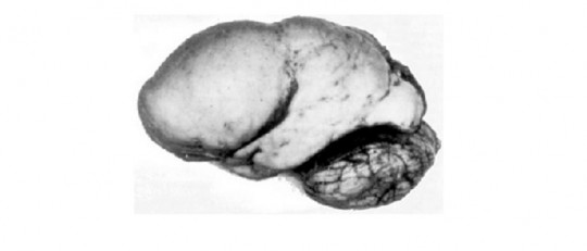 Lisencefalia: síntomas, causas y tratamiento