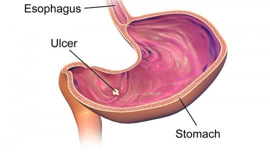 Tipos de úlcera