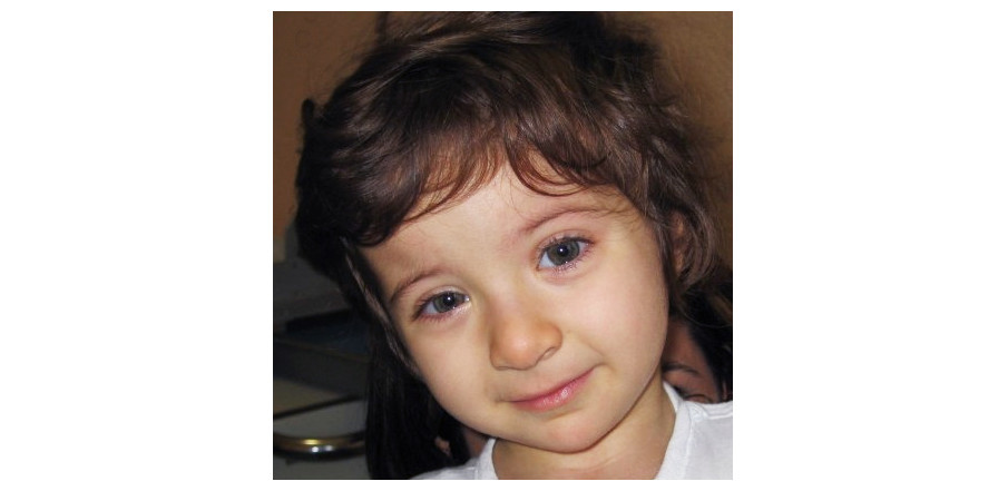 O que é síndrome de Rubinstein-Taybi? - Crianças Especiais