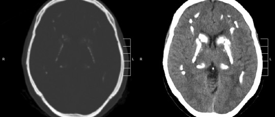 Enfermedad de Fahr: qué es, causas y síntomas principales