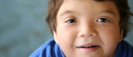 Síndrome de Noonan: causas, síntomas y tratamiento