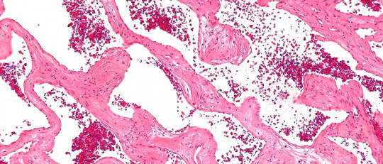 Hemangioma cerebral: causas, síntomas y tratamiento