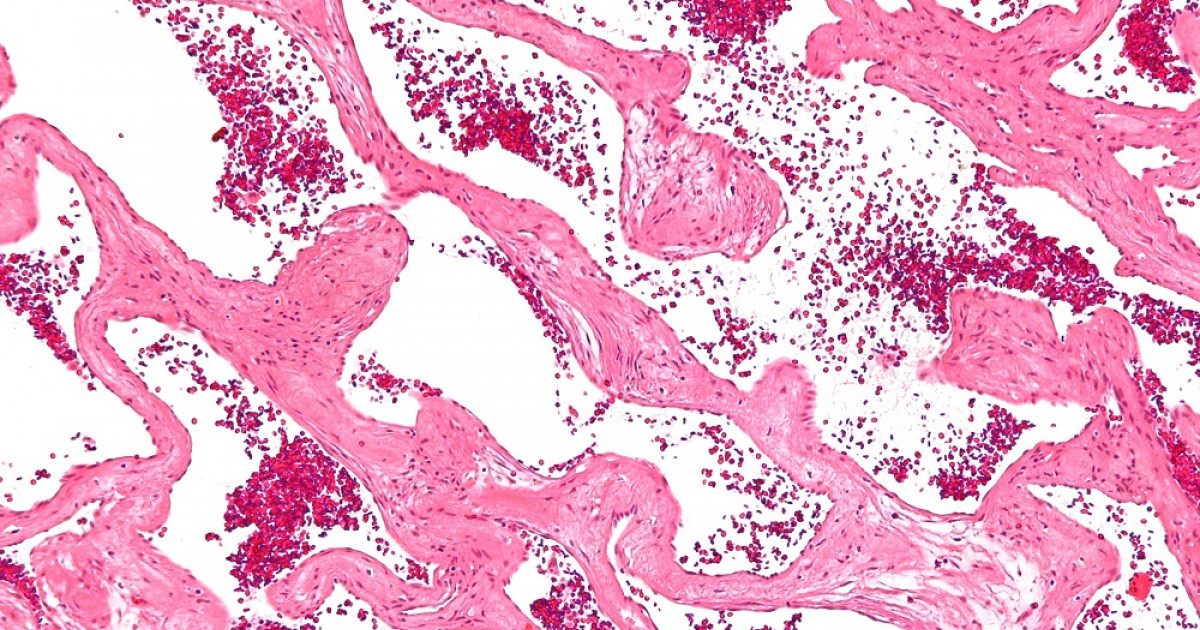 Hemangioma Cerebral Causas Sintomas Y Tratamiento