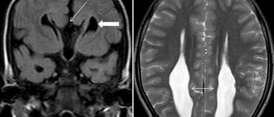 Colpocefalia: qué es, causas, síntomas y tratamiento